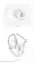 Fig. 07 - Device for percutaneous transcathertral closure of atrial septal defect by deploying pericardial patch