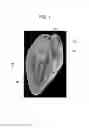 Fig. 02 - Devices and methods for excluding the left atrial appendage
