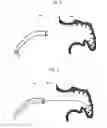 Fig. 06 - Devices and methods for excluding the left atrial appendage