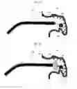 Fig. 08 - Devices and methods for excluding the left atrial appendage