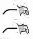 Fig. 09 - Devices and methods for excluding the left atrial appendage