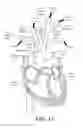 Fig. 02 - IMPLANTABLE DAMPING DEVICES FOR TREATING DEMENTIA AND ASSOCIATED SYSTEMS AND METHODS OF USE