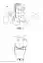 Fig. 05 - Device and method for installing femoral prosthetic knee joint