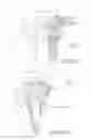 Fig. 08 - Device and method for installing femoral prosthetic knee joint