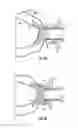 Fig. 04 - Systems for implanting and using a conduit within a tissue wall
