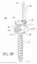 Fig. 03 - Implants for securing spinal fixation elements