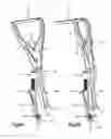 Fig. 08 - Bi-planar persuader