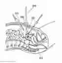 Fig. 01 - METHOD AND PROBE FOR PROVIDING TACTILE FEEDBACK IN LAPAROSCOPIC SURGERY
