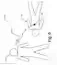 Fig. 07 - Tissue Marking For Lesion Removal