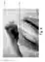 Fig. 10 - Tissue Marking For Lesion Removal