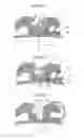 Fig. 03 - LOW PROFILE SELF-LIGATING ORTHODONTIC BRACKET
