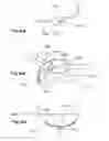 Fig. 50 - Method of treating urinary incontinence