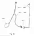 Fig. 53 - Method of treating urinary incontinence