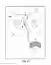 Fig. 55 - Tissue anchor and a suture inserted through the tissue anchor having end portions of the suture maintained within a conduit