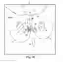 Fig. 59 - Tissue anchor and a suture inserted through the tissue anchor having end portions of the suture maintained within a conduit