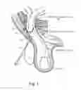 Fig. 02 - Method and prosthesis for percutaneous hernia repair