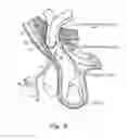 Fig. 06 - Method and prosthesis for percutaneous hernia repair