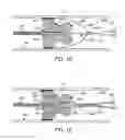 Fig. 03 - Integrated embolic protection devices