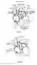 Fig. 04 - Implantable cardio-vascular flow streamliner