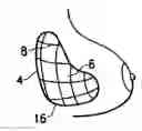 Fig. 01 - Tissue marking implant
