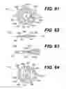 Fig. 15 - Intraocular lens (IOL)