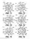 Fig. 17 - Intraocular lens (IOL)