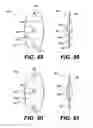 Fig. 20 - Intraocular lens (IOL)