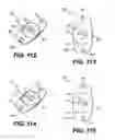 Fig. 24 - Intraocular lens (IOL)