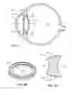 Fig. 02 - Intraocular lens having a capsular ring for inhibiting capsular opacification