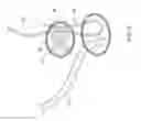 Fig. 07 - Replacement heart valve implant