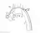 Fig. 01 - Apparatus and method for aortic protection and tavi planar alignment
