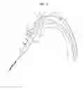 Fig. 05 - Apparatus and method for aortic protection and tavi planar alignment