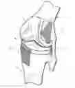 Fig. 01 - External bone anchor system for joint replacement implants