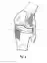 Fig. 02 - External bone anchor system for joint replacement implants