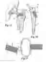 Fig. 07 - External bone anchor system for joint replacement implants