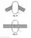 Fig. 08 - External bone anchor system for joint replacement implants