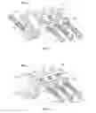 Fig. 02 - Glenoid fossa prosthesis