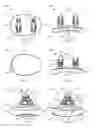 Fig. 03 - Glenoid arthroplasty with multi-directional fixation
