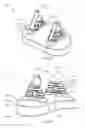 Fig. 08 - Glenoid arthroplasty with multi-directional fixation
