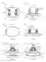Fig. 09 - Glenoid arthroplasty with multi-directional fixation