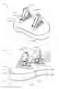 Fig. 12 - Glenoid arthroplasty with multi-directional fixation