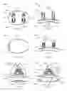 Fig. 15 - Glenoid arthroplasty with multi-directional fixation