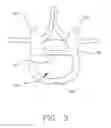Fig. 04 - Multi-lobe artificial spine joint