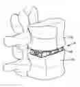 Fig. 01 - Expandable interbody fusion implant