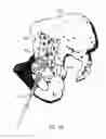 Fig. 10 - Device for attaching a positioning device to a bone of a patient, device for treating a bone of a patient, and hip implant system