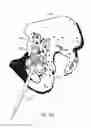Fig. 12 - Device for attaching a positioning device to a bone of a patient, device for treating a bone of a patient, and hip implant system