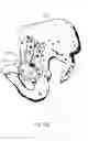 Fig. 15 - Device for attaching a positioning device to a bone of a patient, device for treating a bone of a patient, and hip implant system