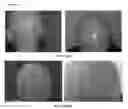 Fig. 03 - A PHARMACEUTICAL COMPOSITION COMPRISING A SUSPENSION OF TOTAL CELLS OBTAINED FROM HAIR FOLLICLE AND PLASMA DERIVED GROWTH FACTORS FOR PROMOTING HAIR FOLLICLE REGENERATION