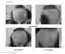 Fig. 04 - A PHARMACEUTICAL COMPOSITION COMPRISING A SUSPENSION OF TOTAL CELLS OBTAINED FROM HAIR FOLLICLE AND PLASMA DERIVED GROWTH FACTORS FOR PROMOTING HAIR FOLLICLE REGENERATION