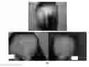 Fig. 05 - A PHARMACEUTICAL COMPOSITION COMPRISING A SUSPENSION OF TOTAL CELLS OBTAINED FROM HAIR FOLLICLE AND PLASMA DERIVED GROWTH FACTORS FOR PROMOTING HAIR FOLLICLE REGENERATION